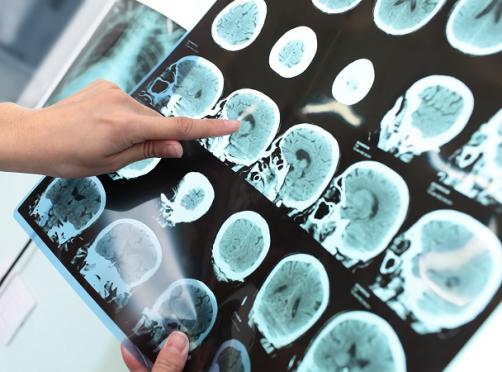 A stroke kezelésével kapcsolatos legújabb kutatási eredmények