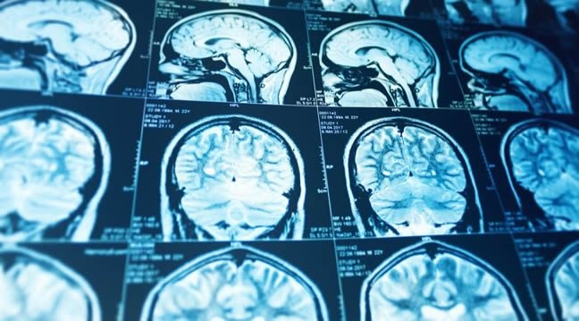 Egyes agyterületek gyulladása is szerepet játszhat az autizmus kialakulásában