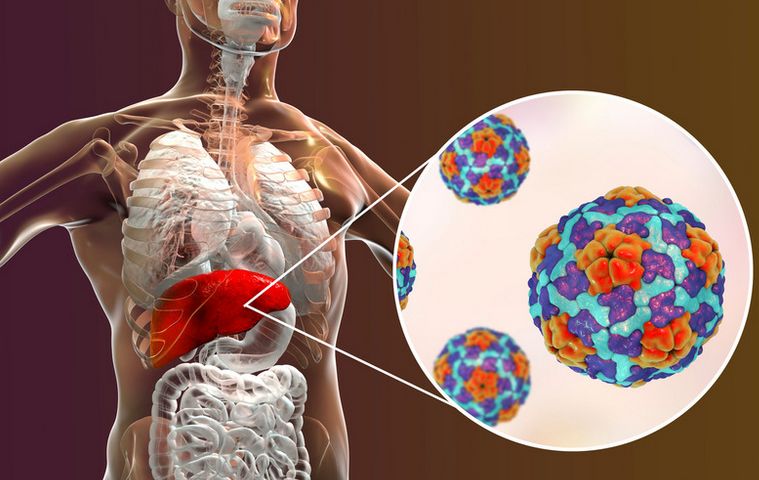 hepatitisz