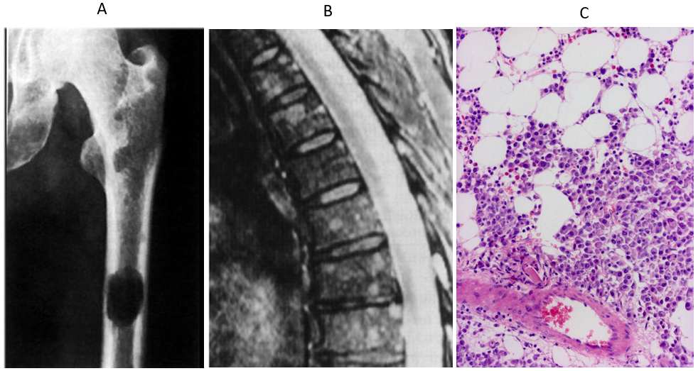 Myeloma multiplex jelei