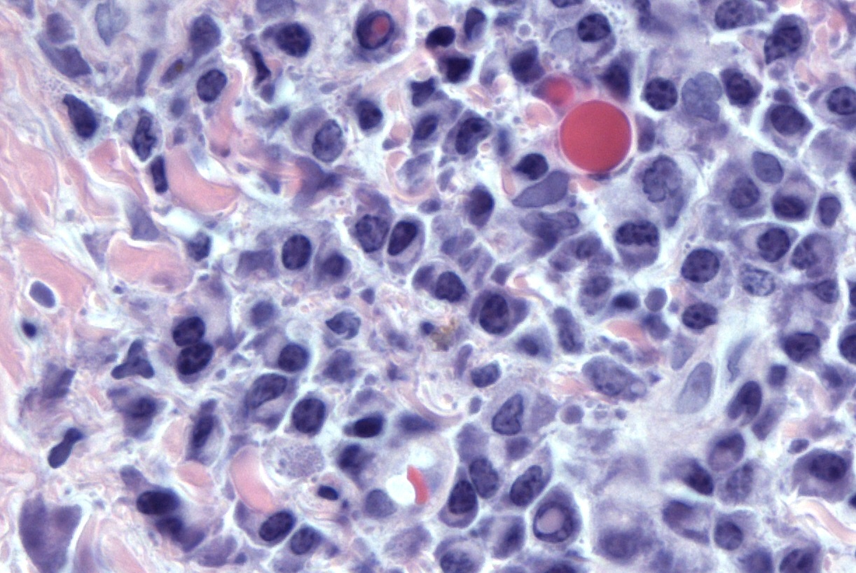 myeloma