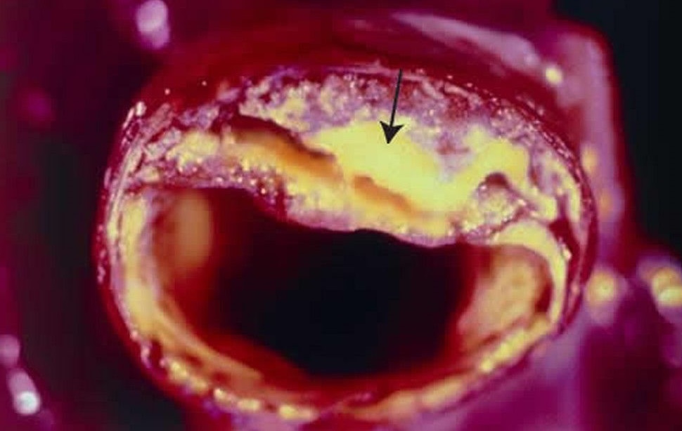 atherosclerotic