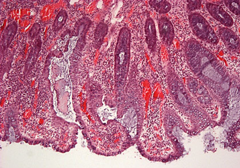 colitis_ulcerosa