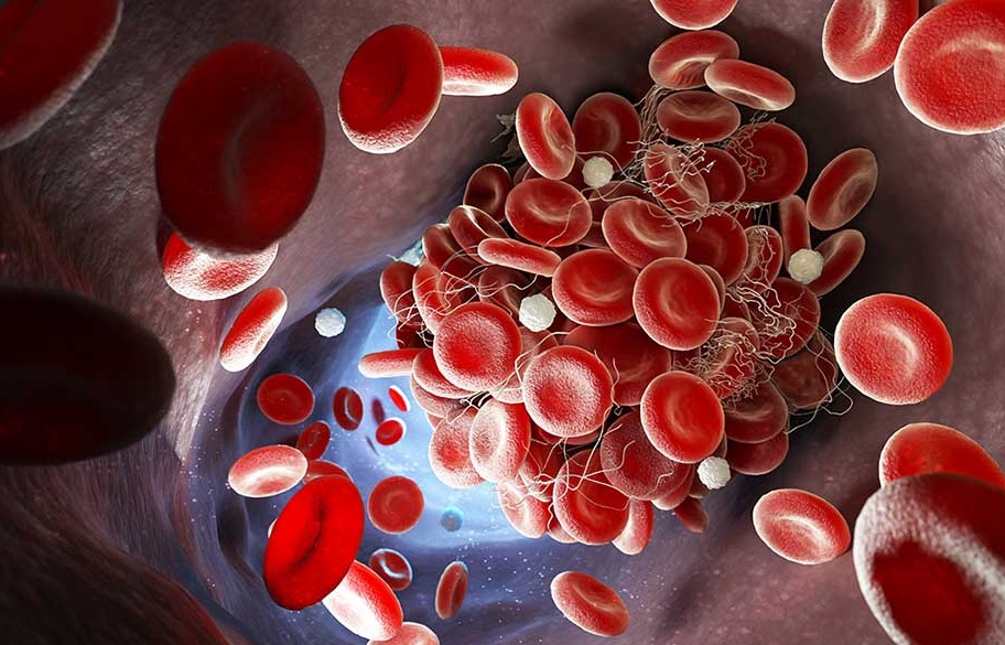 thrombosis