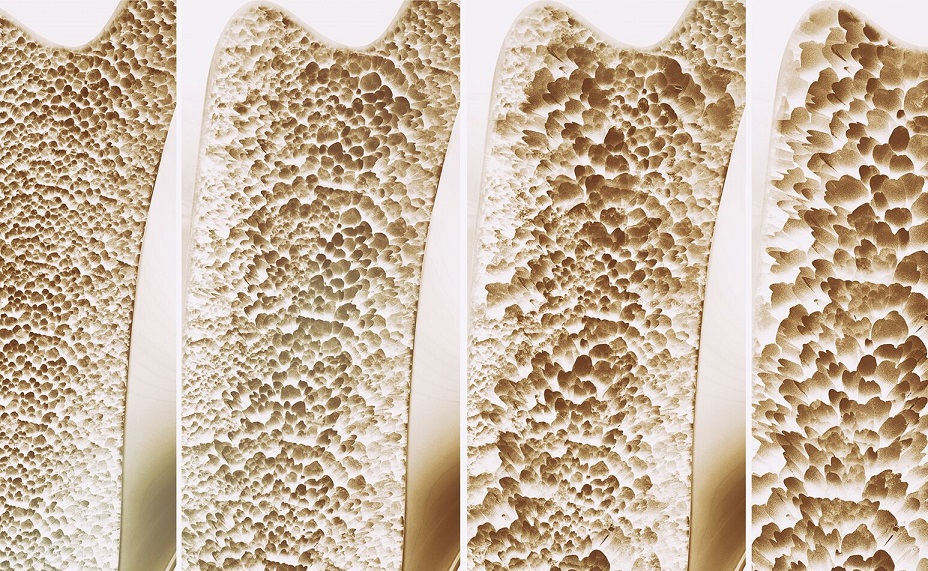 osteoporosis