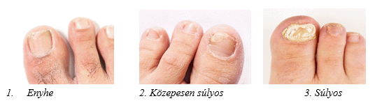 exoterbyn körömgomba ellen lábujjak közötti gombás fertőzés kezelése